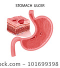 Peptic ulcer in stomach with layers visualization 101699398
