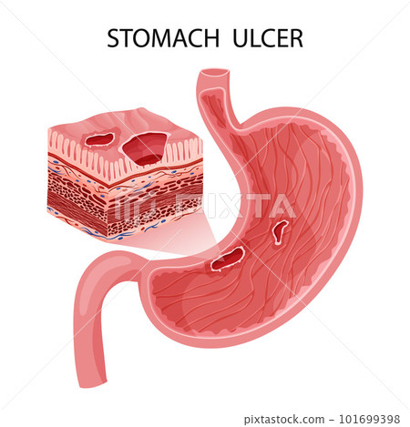 Peptic ulcer in stomach with layers visualization 101699398