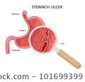 Peptic ulcer in stomach under magnyfication 101699399