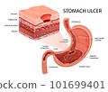 Peptic ulcer in stomach infographic 101699401