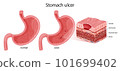 Normal stomach and peptic ulcer illustration 101699402