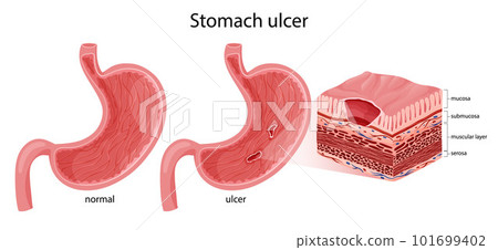 Normal stomach and peptic ulcer illustration Normal stomach and peptic ulcer illustration 101699402