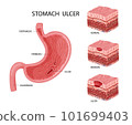 Stomach erosion and ulcer illustration 101699403