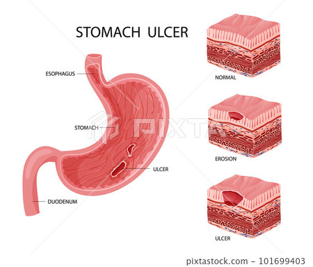 Stomach erosion and ulcer illustration 101699403