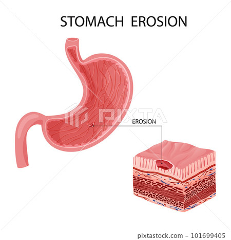 Human stomach erosion vector illustration 101699405