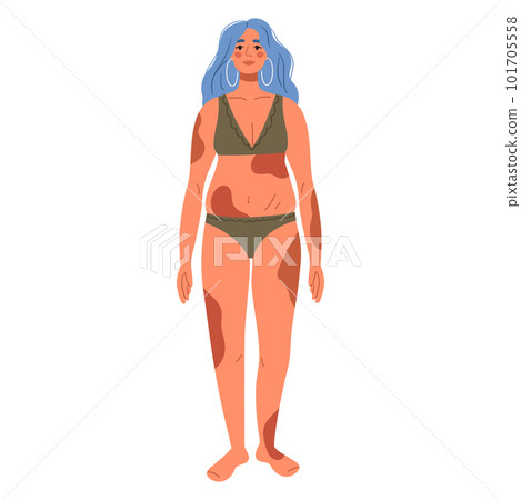 Woman with melasma, dark brown pigment spots on body. Dermatology, cosmetology concept. Skin cancer concept. Inclusion and body-positivity concept. Flat Vector Illustration Woman with melasma, dark brown pigment spots on body. Dermatology, cosmetology concept. Skin cancer concept. Inclusion and body-positivity concept. Flat Vector Illustration 101705558
