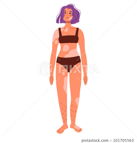 Women with vitiligo in swimsuit. Body-positive women. World vitiligo day. Skin disease Rare diseases. Flat vector illustrations 101705563