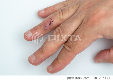 Stitched wound on a finger. Hand with stitched cut wound Stitched wound on a finger. Hand with stitched cut wound 101715175