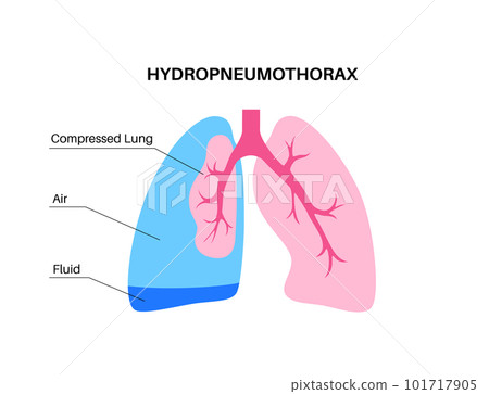 Hydropneumothorax medical poster 101717905