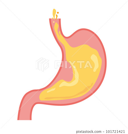 反流性食管炎的形像說明 101721421