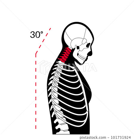 Neck vertebrae deformity 101731924