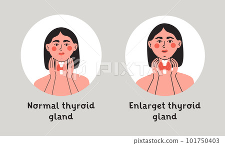 Normal and enlarget thyroid gland. Woman showing thyroid gland on her neck. Endocrinology system symbol, organ responsible for hormone production. Flat vector isolated illustration Normal and enlarget thyroid gland. Woman showing thyroid gland on her neck. Endocrinology system symbol, organ responsible for hormone production. Flat vector isolated illustration 101750403