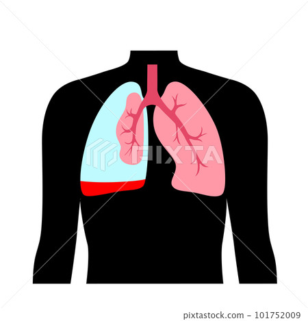 Hemopneumothorax medical poster 101752009