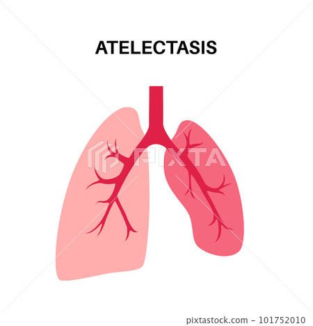 Atelectasis medical poster 101752010