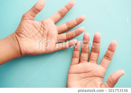 close up of Dry cracked skin of a men's hand close up of Dry cracked skin of a men's hand 101753536