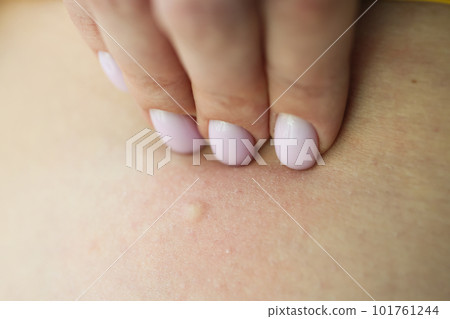 Female hand touches skin with rash examining eczema 101761244