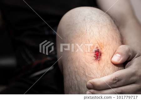 Closeup of fresh wound on man's knee from accident. 101779717