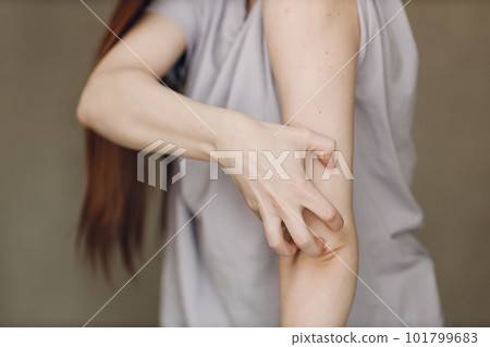 Allergy dermatology scabies itches hand skin problem woman 101799683
