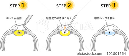圖庫插圖: 說明白內障手術的流程（帶主線） 101801364