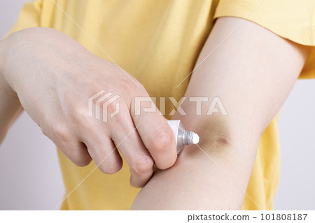 Closeup Female Person Applies Healing Cream, Ointment On Hematoma, Bruise After Injection, Blood Sampling From Metal Tube. Injury Treatment, Cure. Post-injection phlebitis. Horizontal plane 101808187