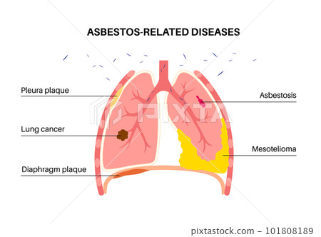 Asbestos related diseases Asbestos related diseases 101808189