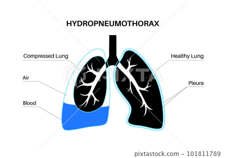 Hydropneumothorax medical poster 101811789