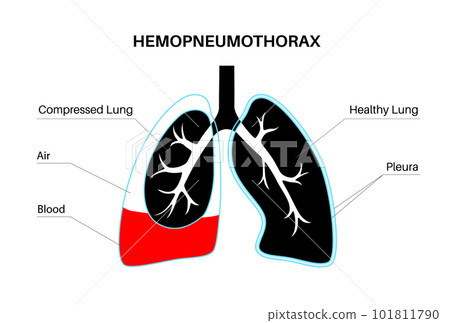 Hemopneumothorax medical poster 101811790