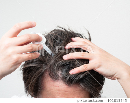 一個男人在頭皮上塗生髮劑 頭皮護理 101815545