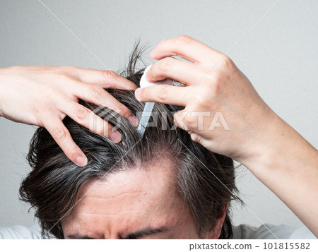 A man applying a hair restorer to his scalp Scalp care 101815582