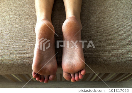 Dry cracked skin of woman feet in bed. Foot treatment. Dry cracked skin of woman feet in bed. Foot treatment. 101817033
