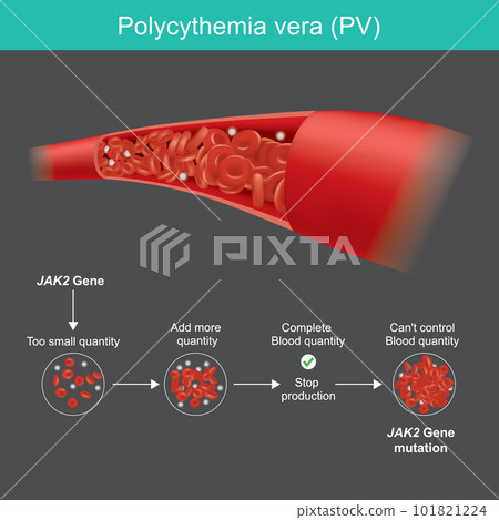 Polycythemia vera. Too much red blood cells...-插圖素材 [101821224] - PIXTA圖庫