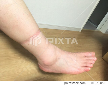 Swollen feet 1, rubber marks 101821855