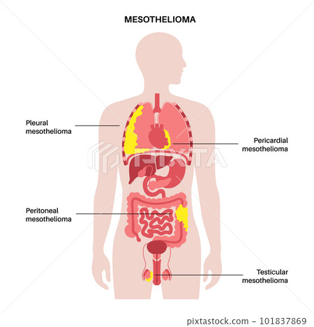 Mesothelioma tumor types Mesothelioma tumor types 101837869