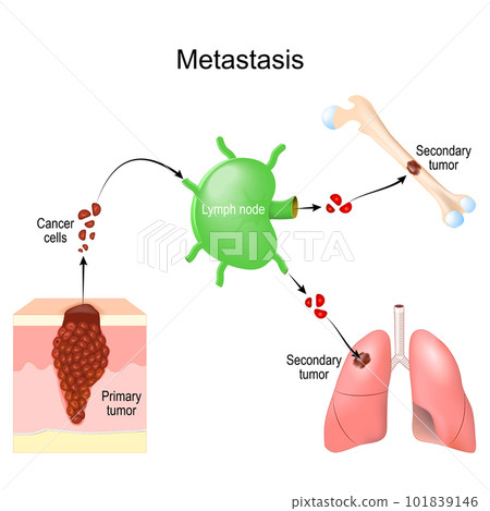Metastasis. cancer invasion. malignant tumor. Metastasis. cancer invasion. malignant tumor. 101839146