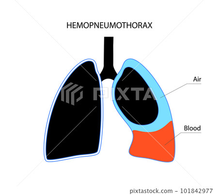 Hemopneumothorax medical poster 101842977