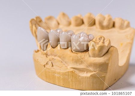 Dental prosthesis Dental prosthesis 101865107