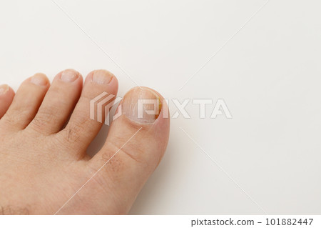 運動員的腳在白色背景上的男人的拇指指甲上 101882447