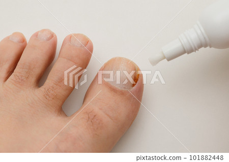 拇指指甲的香港腳治療 拇指指甲的香港腳治療 101882448