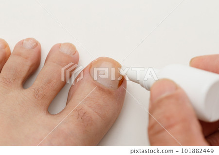 Athlete's foot treatment for thumb nails 101882449