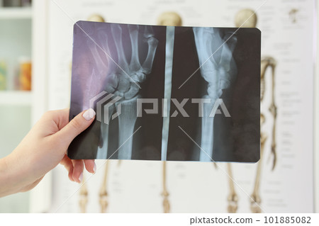 X-ray image of patient palm bones in orthopedist hand 101885082