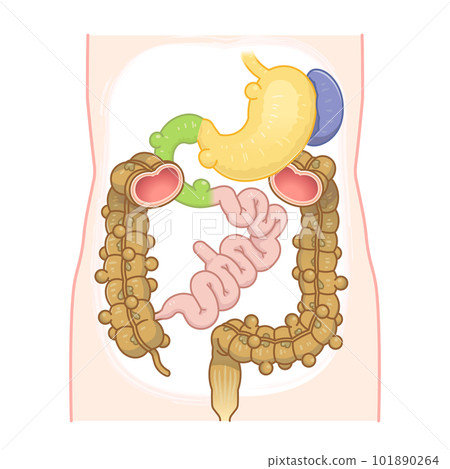 結腸憩室圖解 憩室穿孔 憩室 憩室 梅克爾憩室 梅克爾憩室癌 101890264