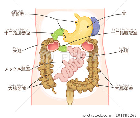 結腸憩室圖解 憩室穿孔 憩室 憩室 梅克爾憩室 梅克爾憩室癌 101890265