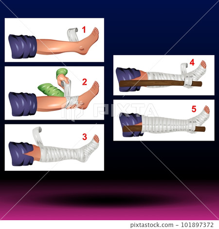 Treatment of Broken Leg 101897372