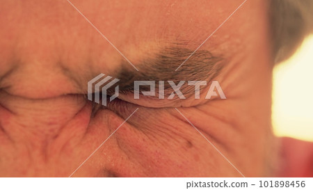 Man with bruised eye squints Man with bruised eye squints 101898456