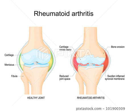 Rheumatoid arthritis. Rheumatoid arthritis. 101900309