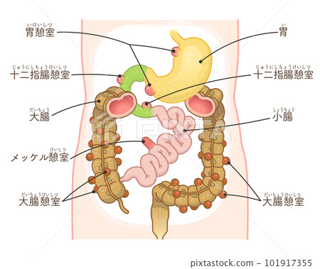 結腸憩室圖解 憩室穿孔 憩室 憩室 梅克爾憩室 梅克爾憩室癌 101917355