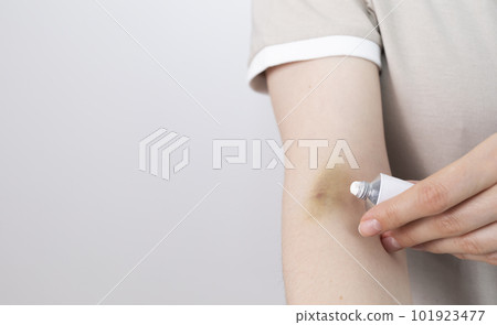 Someone Applies Healing Cream, Ointment On Hematoma, Bruise After Injection, Blood Sampling From Metal Tube. Cure.Post-injection phlebitis. Copyspace For Text. Horizontal plane. 101923477