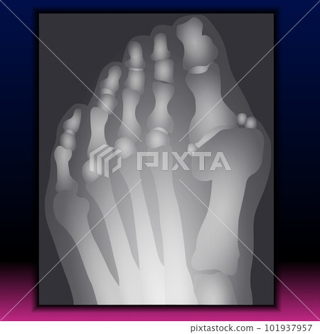 X-ray of Foot X-ray of Foot 101937957