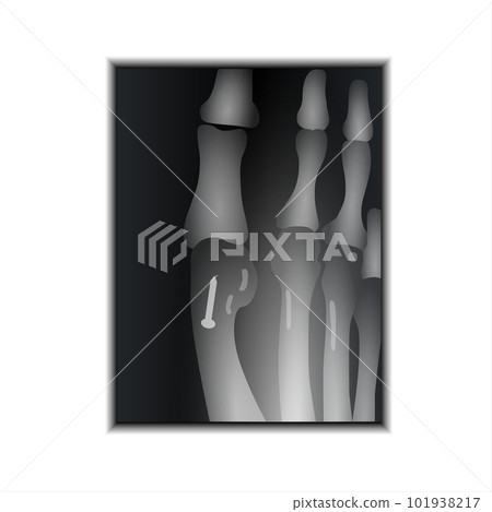 X-ray of Foot Claw 101938217