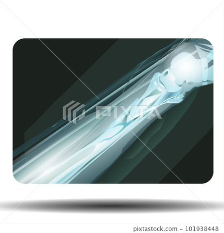 X-ray of Fracture Bone 101938448